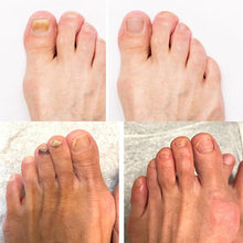 Afbeelding in Gallery-weergave laden, DermaNail - Gepatenteerde nagelschimmeltherapie – voor gezonde nagels binnen 4 weken